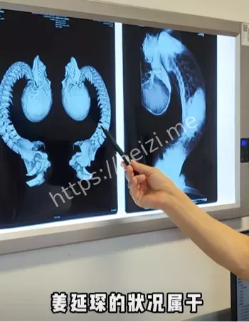 反向折叠人手术