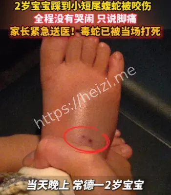 宝宝被蝮蛇咬伤